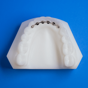Mesh Fixed Lingual Retainers Ordont