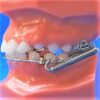 X-Bow Class II Corrector Ordont