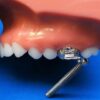 X-Bow Class II Corrector Ordont