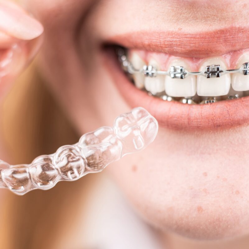 Hybrid Orthodontic Treatment: Patient & Practice Benefits - Ordont